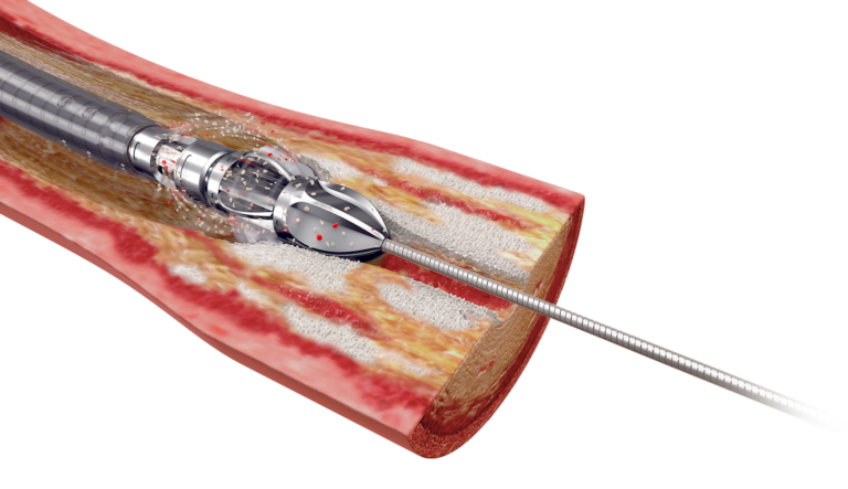 経皮経管血管形成術とは何ですか?